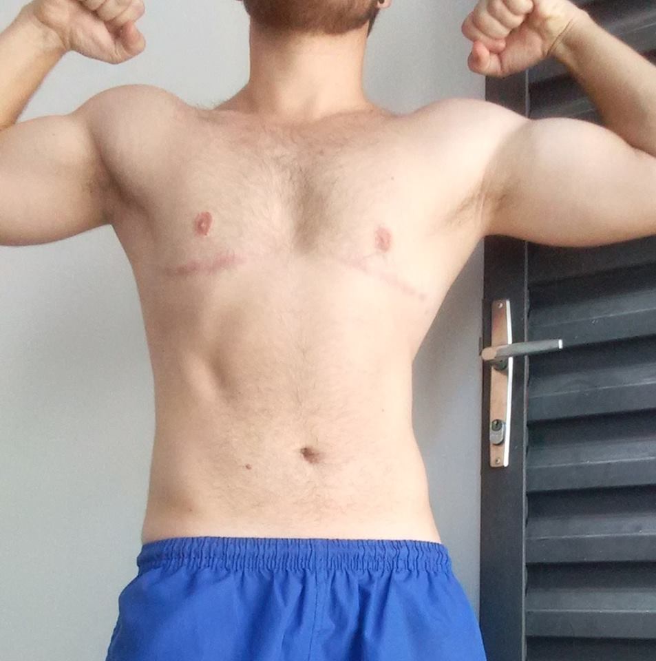 Foto de Janeiro de 2018 com um ano e meio pós-op.