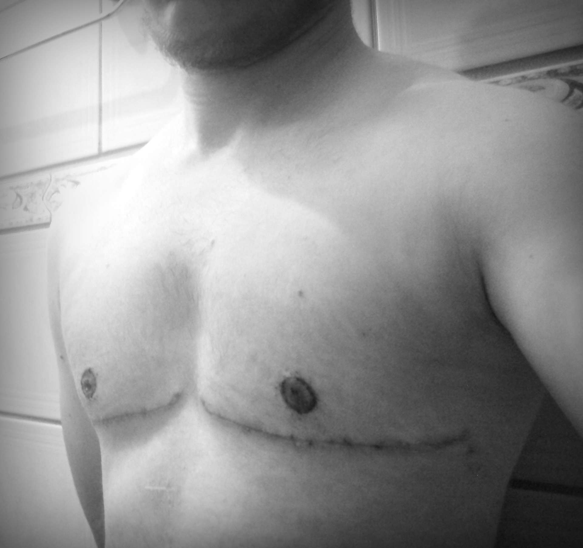 15 dias pós-op. sem os pontos