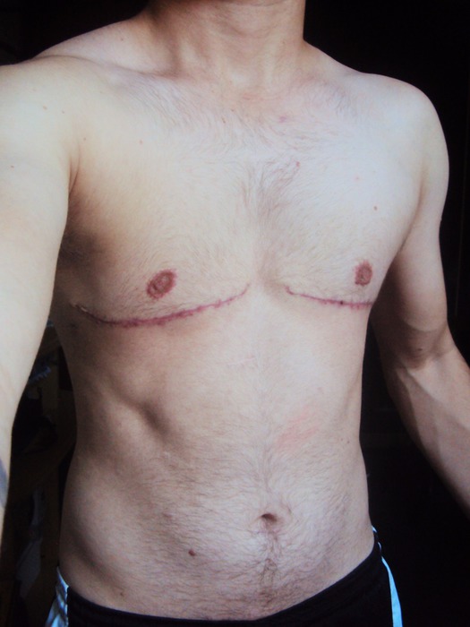 45 dias pós-operatório